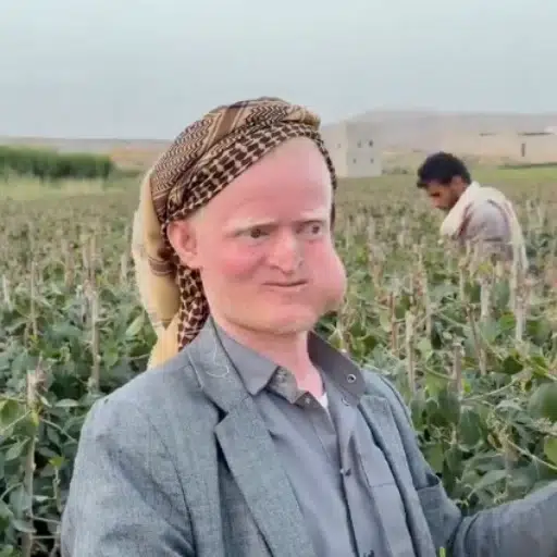 The Popeye Albino